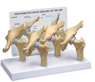 4-stupňové degenerativní kostní choroby modelu kyčle (Anatomické modely)