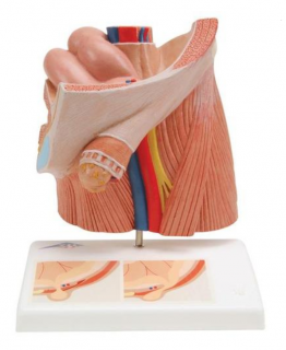 Model inguinální hernie (Anatomické modely)