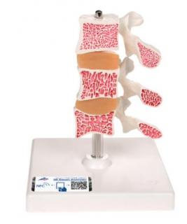 Model lidských bederních obratlů s osteoporózou (Anatomické modely)