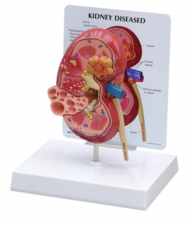 Model onemocnění ledvin (Anatomické modely)