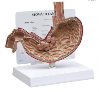 Model rakoviny žaludku (Anatomické modely)