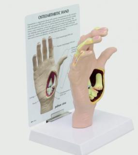 Model ruky s osteoartrózou (Anatomické modely)