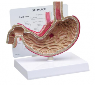 Model žaludku s vředy (Anatomické modely)