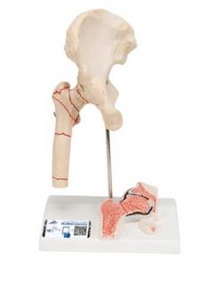 Model zlomeniny lidské stehenní kosti a osteoartrózy kyčle (Anatomické modely)