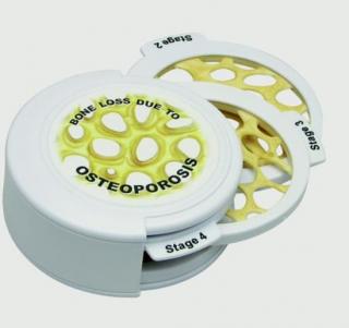 Sada kloubových disků - 4ks Osteoporóza (Anatomické modely)