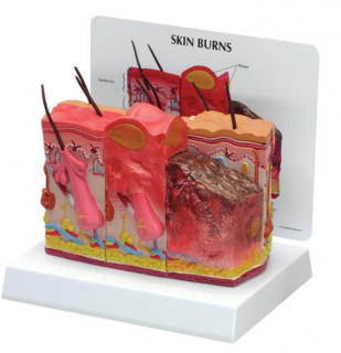 Série lidské pokožky s popáleninami, 75 krát životní velikost (Anatomické modely)
