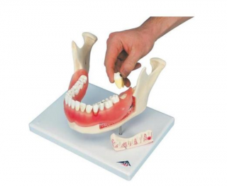 Zubní onemocnění, zvětšené 2 krát, 21 částí (Anatomické modely)