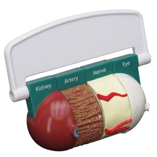 Čtyřdílný model cukrovky