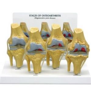 Čtyři stádia osteoartritidy kolena
