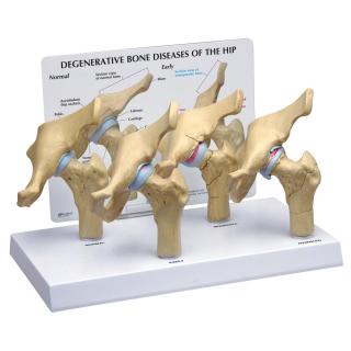 Model čtyř fází osteoartritidy