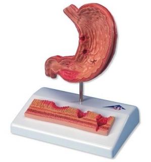 Model žaludku s vředy