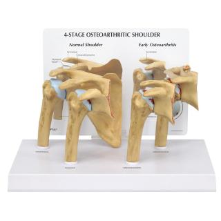 Sada modelů ramene s osteoartrózou