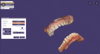 Exocad - CAD software Modul: Bite