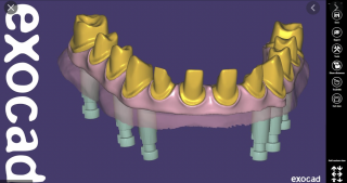 Exocad - CAD software Modul: Core - základní verze