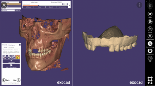 Exocad - CAD software Modul: Dicom wiewer