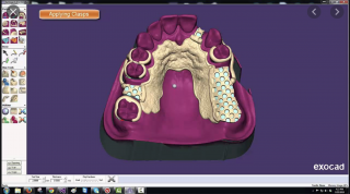 Exocad - CAD software Modul: Parcial CAD