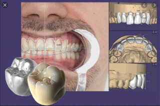 Exocad - CAD software Modul: TruSmile